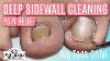 Big Toes Only Deep Sidewall Cleaning Toenail Relief